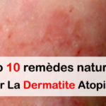 10 remèdes naturels pour la dermatite atopique