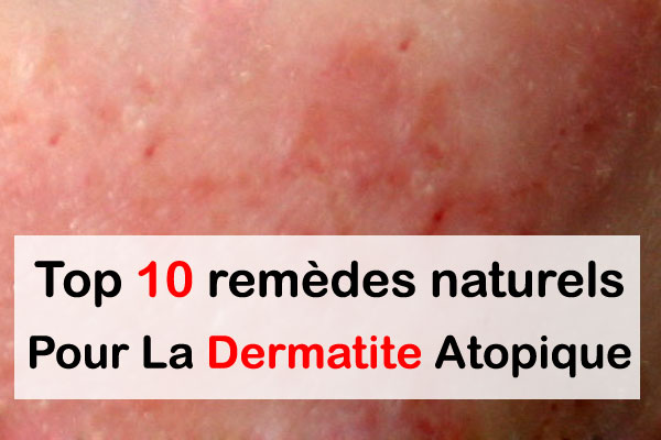 10 remèdes naturels pour la dermatite atopique